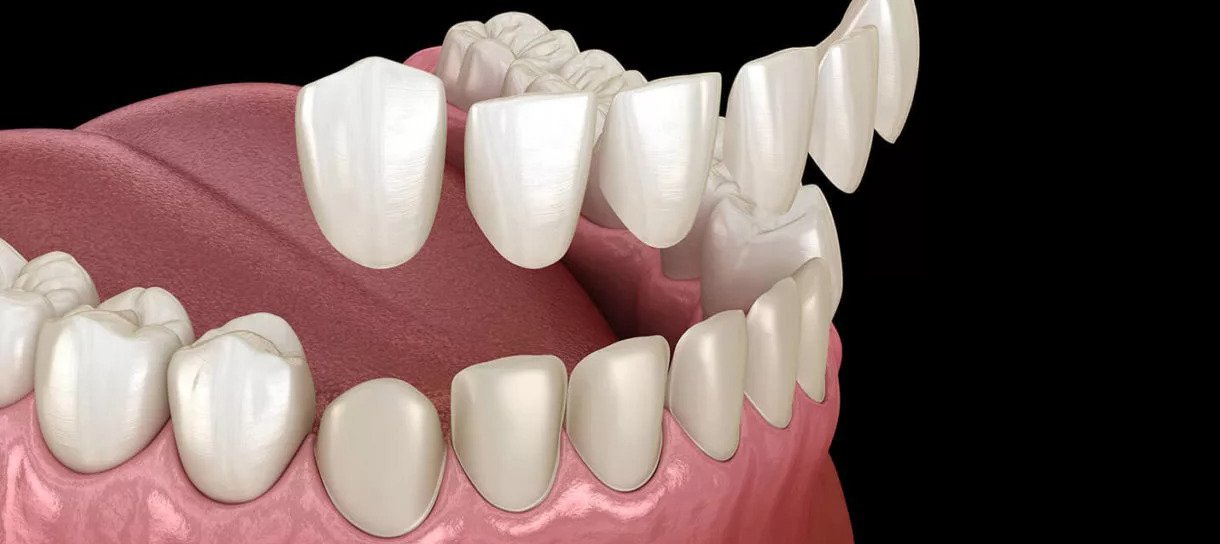 resources of Porcelain Veneer, Dental Laminates exporters