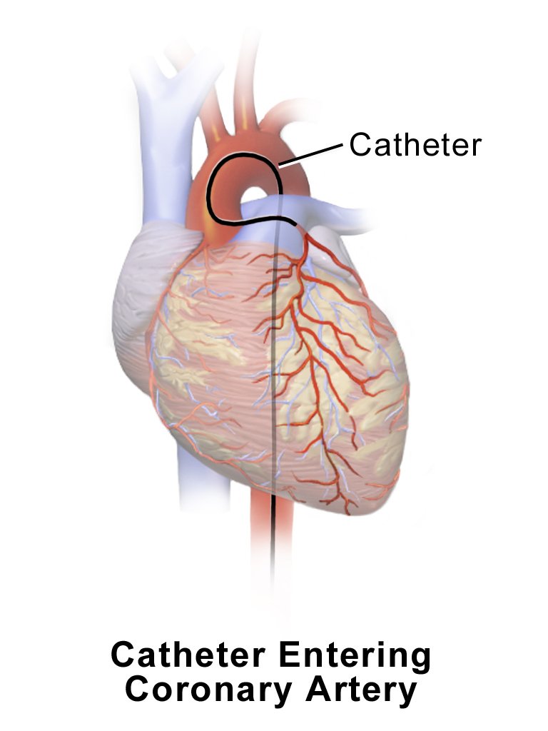 resources of Cordis Optease Retrieval Catheter Cordis 466-C210F exporters