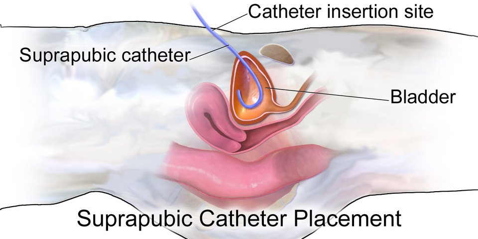 resources of Medtronic Launcher guiding catheter all codes exporters